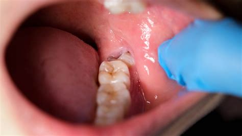 pericoronitis explained symptoms treatment  care tips
