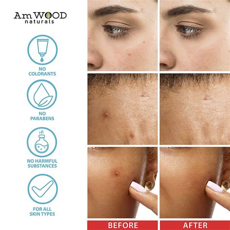 Hyaluronic Acid Acne Patches with Salicylic Acid & Tea Tree Oil - 120