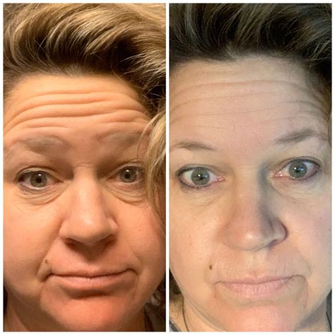 what helps bags under eyes 4