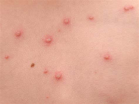 Can My Baby Get Chickenpox After Vaccine at Ashton Roberts blog