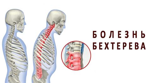 Что нужно знать о болезни Бехтерева - YouTube