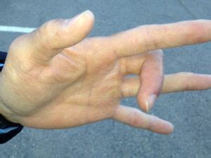 Jammed Fingers | OrthoSouth