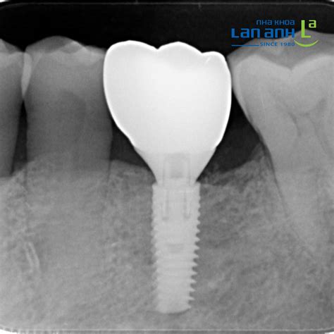 What does the durability of Implant depend on