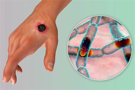 Anthrax Disease - Symptoms and Treatment - FAQs