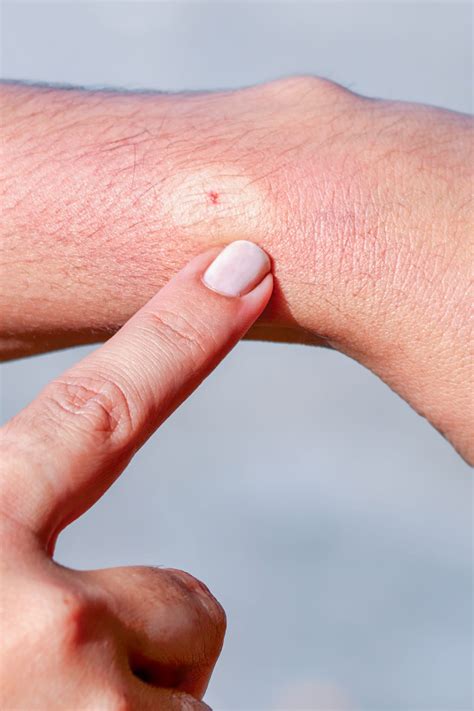 Bee Sting Pictures - What Does a Bee Sting Look Like?
