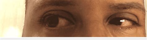Bilateral conjunctivitis presentation in the patient after recovery ...