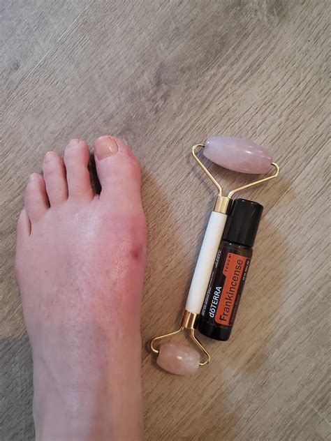 Scar care : r/bunions