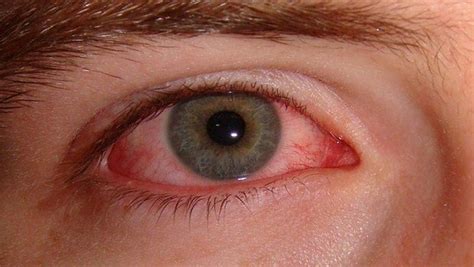 Effective Home Remedies for Relieving Burning Eyes Irritation - Hunter Games Magazine