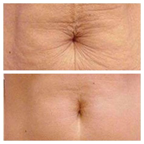 Skin tightening on the stomach | Plasma Pen London