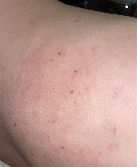 Please help identify rash?! : r/medical