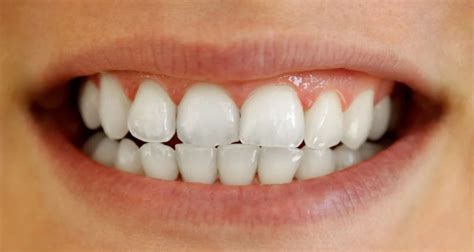teeth contouring  benefits  enhance  perfect smile