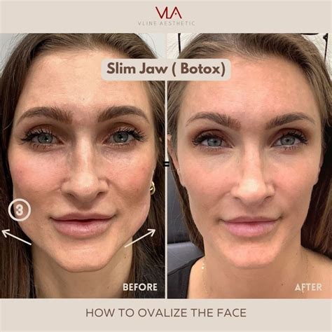 Non-Surgical Face Slimming - V LINE AESTHETICS