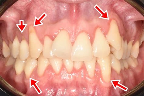 Apiñamiento dental: Soluciones rápidas | Solución Dental