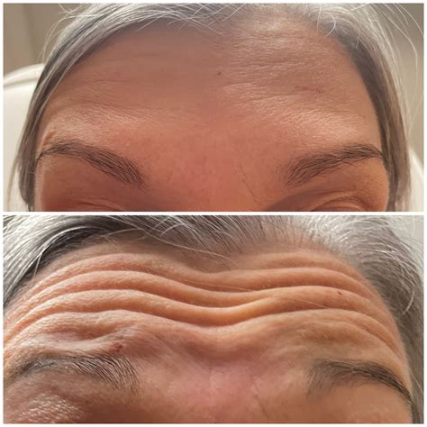 forehead line botox 9
