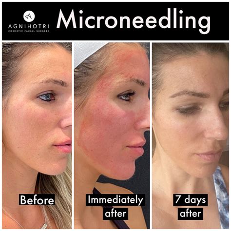 Microneedling Collagen Induction - Agnihotri Cosmetic Facial Surgery