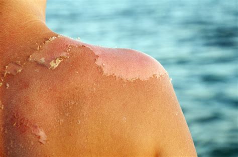 treat  heal sunburn fast popsugar beauty