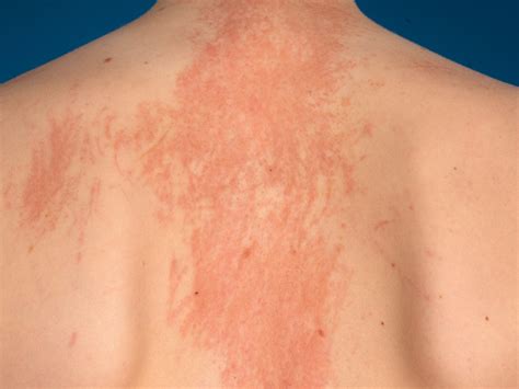 Shiitake Dermatitis Syndrome at Indiana Houlding blog