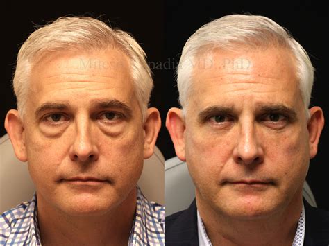 Before and two weeks after upper and lower blepharoplasty surgery
