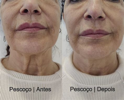 Hifu Antes E Depois - Super HIFU - Results in the 1st Session