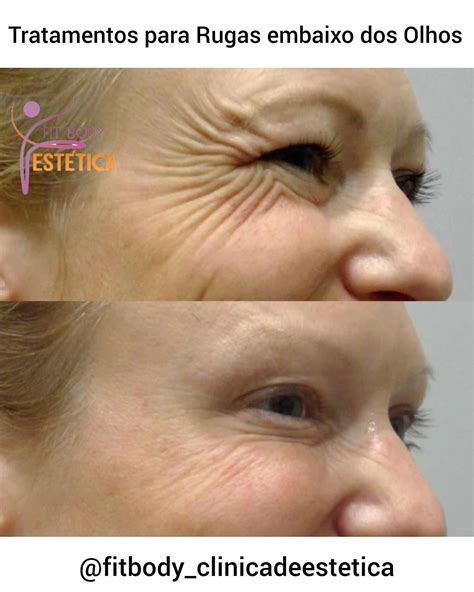 Tratamentos para Rugas embaixo dos Olhos - Clínica Fit Body Estética