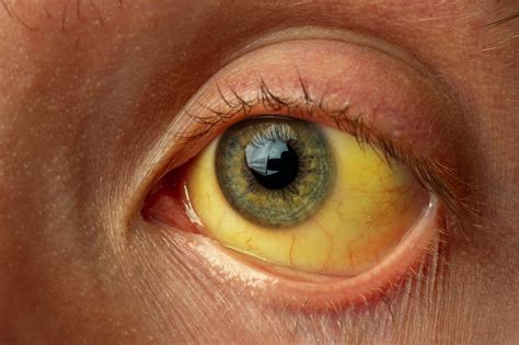 Jaundice Causes And Prevention