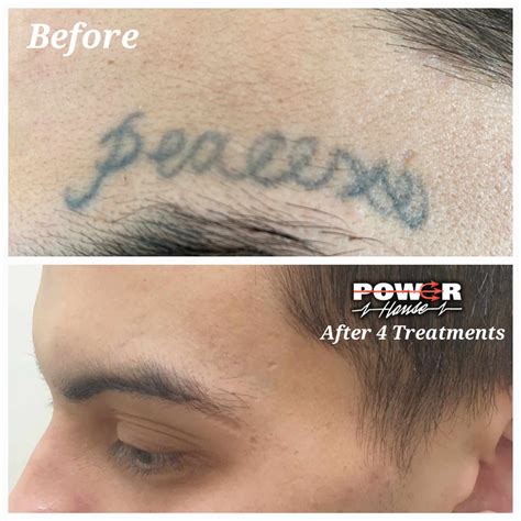 laser tattoo removal how many treatments 11