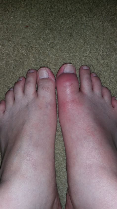 This is what gout looks like... after this picture I pissed in a milk