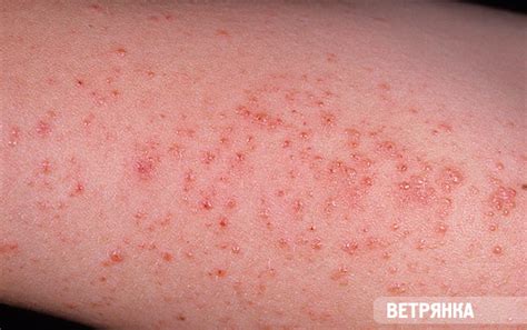 Red Spots On Shins