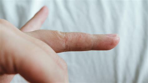 What Is Dyshidrotic Eczema In 2021 Eczema Treatment Skin Conditions