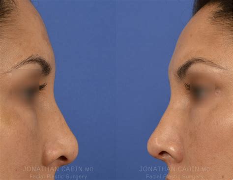 surgical rhinoplasty cabinmd facial plastics aesthetics
