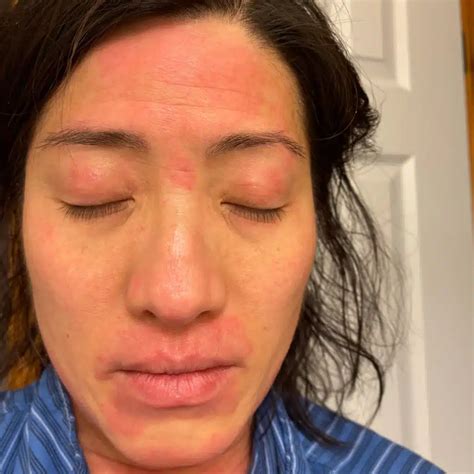 topical   steroid  dermatological condition dr ben medical