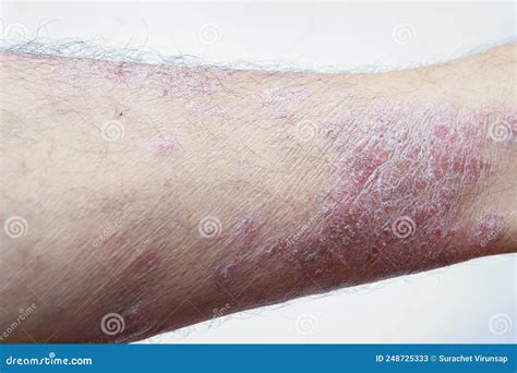 Exacerbation of psoriasis. stock image. Image of brown - 248725333