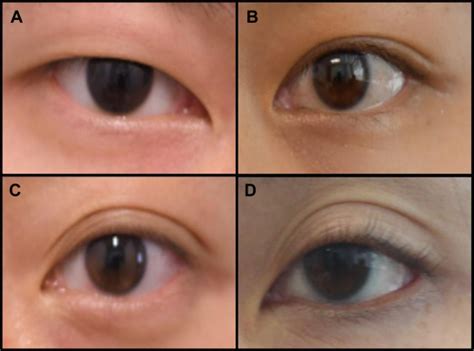 managing  asian eyelid facial plastic surgery clinics