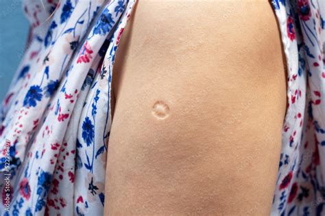 bacillus calmette guern vaccine bcg  tb vaccine scar mark   arm