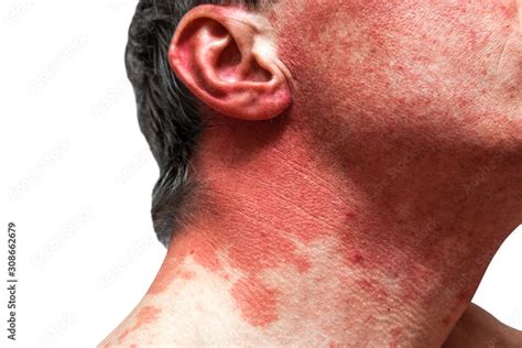 Skin allergy to the human body. Skin diseases Stock Photo | Adobe Stock