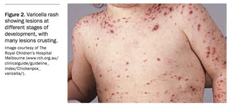 Varicella – more than just a rash | Medicine Today