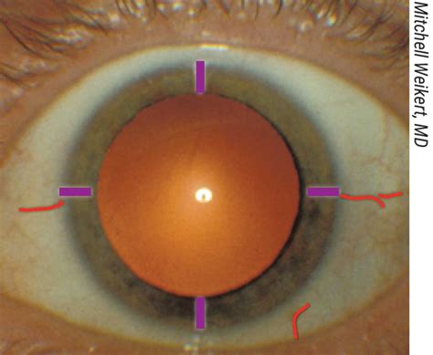 tips  toric marking alignment