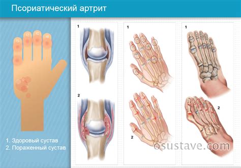 Тендинит стопы, голеностопного сустава, воспаление связок: причины и ...