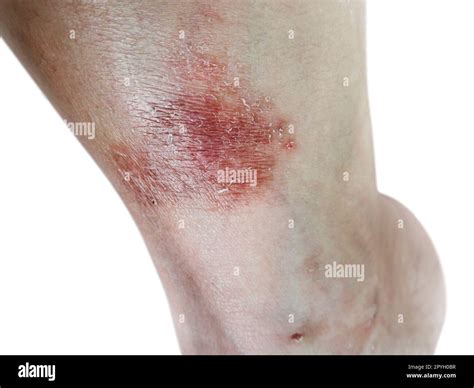 Close up dermatitis on skin, ill allergic rash dermatitis eczema skin ...