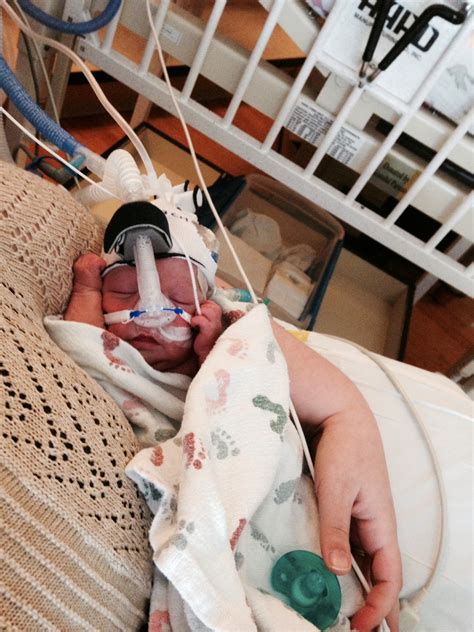 Natalie Rose - Daily Update of our Micro Preemie: PDA Ligation Surgery