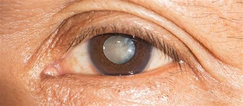 manage  senile cataract patient