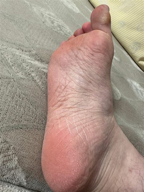 Warum sind meine Füße so hässlich? (Zeh, nägel, Schuhe)