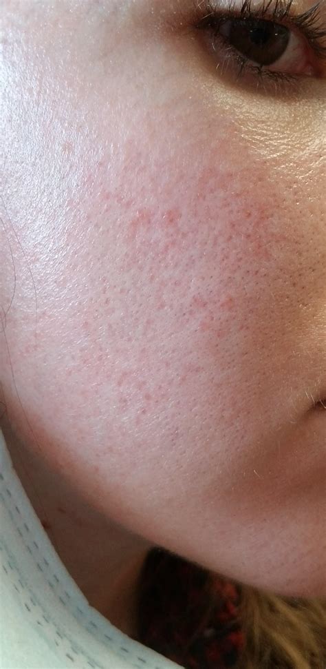 Itchy Skin Rash Dairy Allergy at Faye Garcia blog