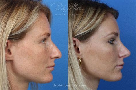 rhinoplasty nasal bridge    rhinoplasty nose jobs nose