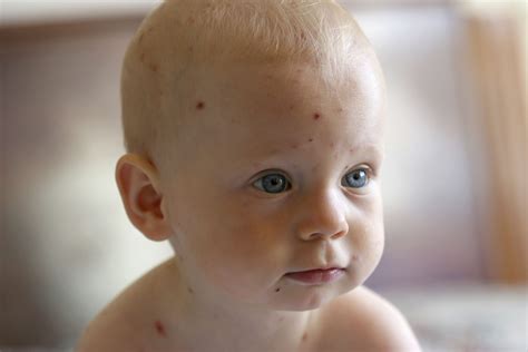 More than half of chickenpox diagnoses are wrong, study finds - Ars