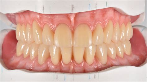 Full dentures at the highest esthetic level - CANDULOR AG