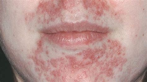 O Que É Dermatite Perioral - Dermatite perioral: o que é, causas, sintomas e tratamento