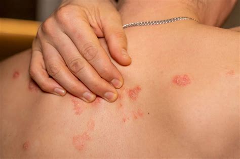Pain Relief for Shingles: Managing Nerve Pain & Discomfort
