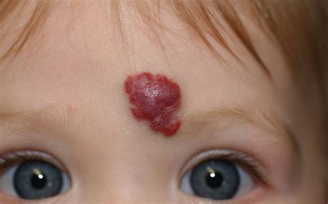 O Que É Um Hemangioma - Hemangioma - O que é, Causas e Tratamentos! | Cura Natural