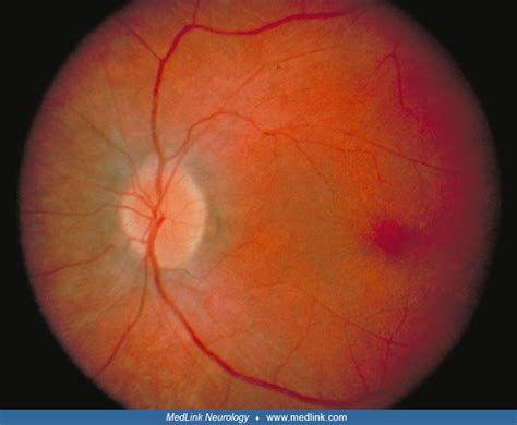 Batten S Disease at Louise Collier blog